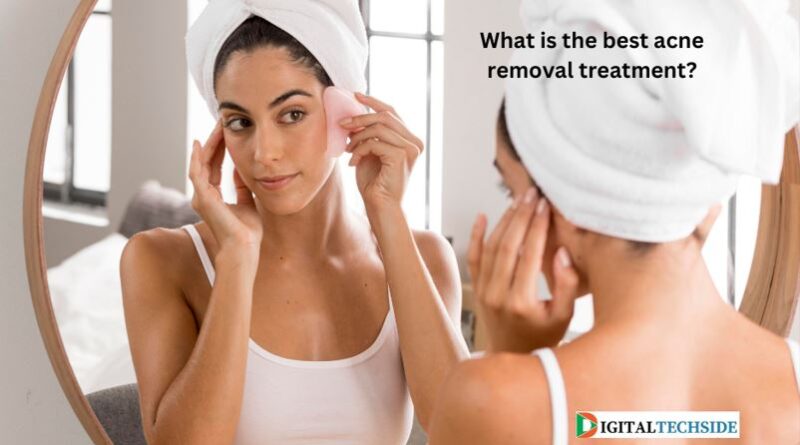 What is the best acne removal treatment?
